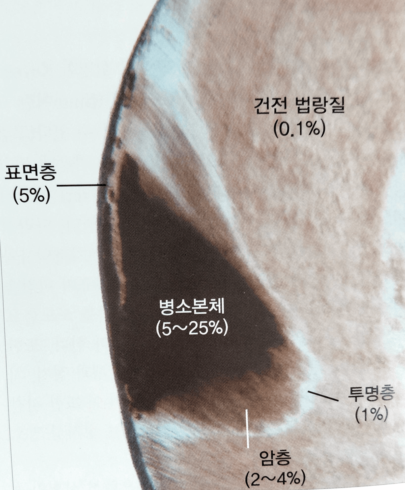 법랑질에 국한된 우식